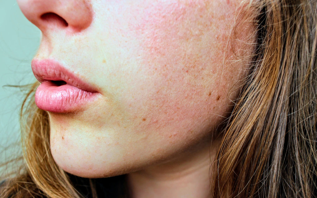 Dermatita atopica - ce este si cum se trateaza